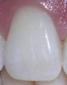Teeth incisor.jpg